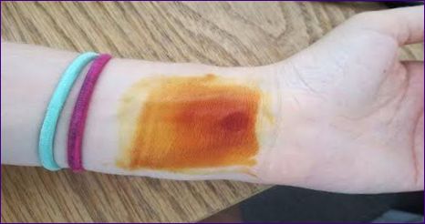 Hvordan fjerne jod fra huden raskt og trygt